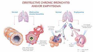 Among other things, chronic bronchitis is called smoker's bronchitis, simple bronchitis, purulent bronchitis, cigaret cough or morning cough. What Is Copd