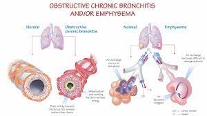 These conditions commonly affect normal airflow in the airways and lungs. What Is Copd