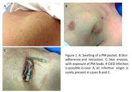 Icd vs pacemaker icds and pacemakers are surgical implants made to help our heart have a regular rhythm. Cardiovascular Implantable Electronic Device Infection Diagnosis And Treatment