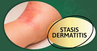 Image result for Stasis Dermatitis