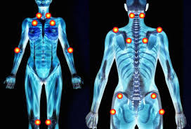Fibromyalgia Pictures Flare Ups Rash Trigger Points And More