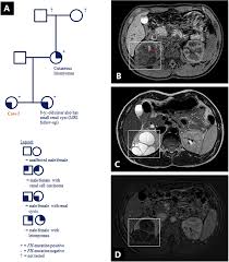 Symptoms of kidney cancer include blood in the urine, giving the urine a rusty, pink, or dark red appearance.persistent pain in the side (flank) is another common symptom, along with an abdominal mass or lump, fever, weight loss, tiredness, and a general feeling of being unwell.however, noncancerous conditions like cysts, benign tumors, or infections are the most common causes of these symptoms. Renal Cell Carcinoma In Young Fh Mutation Carriers Case Series And Review Of The Literature Springerlink