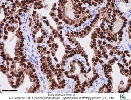 Pathology Outlines Napsin A