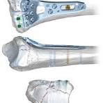 Medartis | Distal Radius and Distal Ulna System 2.5