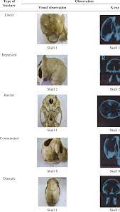 With head injuries due to impact, you do not need to fracture the skull to injure the brain, and, yes, direction of impact matters. Types Of Skull Fractures Encountered Download Table