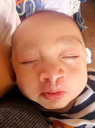 I had my 40th surgery for my cleft lip and palate care a few days ago and  the home nurses, Zoloft (gray boy) and Lexapro (Tortie girl), have been top  tier. The