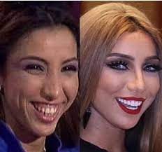 التغير في دنيا بطمة لم يقف فقط عند تغير ملامح وجهها، وإنما متلكت دنيا بطمة جسم بمواصفات مختلفة، ولكن البعض أرجع تحول جسمها إلى ممارستها للرياضة، فيما أرجع آخرون الأمر لعمليات نحت الجسم، خاصة وأن بطمة تظهر عادة بخصر. Ø¨Ø§Ù„ØµÙˆØ± Ø´Ø§Ù‡Ø¯ÙˆØ§ ÙƒÙŠÙ ÙƒØ§Ù†Øª Ø¯Ù†ÙŠØ§ Ø¨Ø·Ù…Ø© Ù‚Ø¨Ù„ Ø¹Ù…Ù„ÙŠØ§Øª Ø§Ù„ØªØ¬Ù…ÙŠÙ„ Ù„Ù† ØªØ¹Ø±ÙÙˆÙ‡Ø§ Ø§Ù„Ù…Ø¯ÙŠÙ†Ø© Ù†ÙŠÙˆØ²