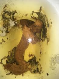 Image result for thin ribbon stools human poop