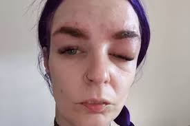 Mum 'left looking like Quasimodo after life-threatening allergic reaction  to eyebrow tint'