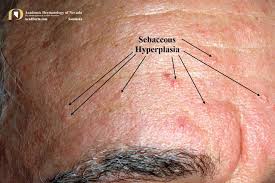 Image result for Sebaceous Hyperplasia
