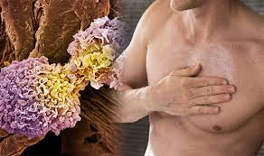 Although breast cancer most often affects women, it can affect men too. Breast Cancer Symptoms In Men Small Bumps In The Armpit Could Be Sign Of Deadly Disease Express Co Uk