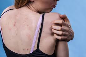 Image result for Keratosis pilaris