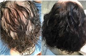 A biotin deficiency will cause the hair to fall out. The Causes Of Hair Loss And How To Repair It