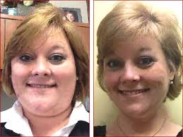 Michelle: LAP-BAND Surgery