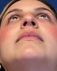 Resultado, apenas 14 días después de su RINOPLASTIA. Observen cómo se  publica las fotos en el consultorio, sin maquillajes, sin montajes , sin  editarlas. ! Tal como está la paciente !