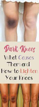 How to prevent darkening of knees? Dark Knees What Causes Them And How To Lighten Your Knees How To Lighten Knees Post Inflammatory Hyperpigmentation Lighten Skin