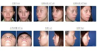Whats people lookup in this blog: Bulbous Nose Correction Wish Aesthetic Surgery Clinic