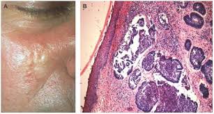 Skin cancer — the abnormal growth of skin cells — most often develops on skin exposed to the early detection of skin cancer gives you the greatest chance for successful skin cancer treatment. Management Of Nonmelanoma Skin Cancer In 2007 Nature Reviews Clinical Oncology