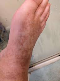 Image result for liver spots on legs