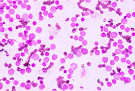 It is common in children, but leukemia most often occurs in adults older than 55. Dia Mundial De Concienciacion Sobre La Leucemia Mieloblastica Aguda El Medico Interactivo