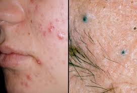 Cystic acne should be treated by a dermatologist. Pictures Of Skin Diseases And Problems Acne