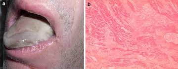 Necrosis comes from the greek origin nekrōsis meaning death and later moved to modern latin to necrosis. Tongue Necrosis As A Complication Of Vasoconstrictor Agents In The Intensive Care Setting Springerlink