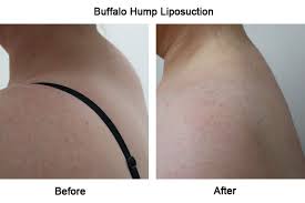 28+ back neck name tattoos / another infection making lumps is the boil. Buffalo Hump Dorsocervical Fat Pad Removal