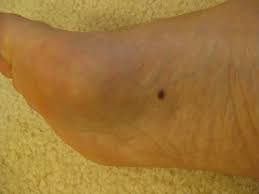 Aside from looking like a changing mole, a melanoma on the foot can appear as a: Skin Cancer On Foot Skin Check Houston Podiatrist Tanglewood Foot Specialists