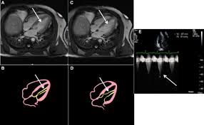 Image result for Left Ventricular Outflow Obstruction