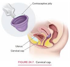 Image result for Contraceptive Sponge