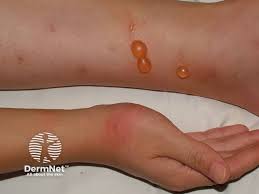 Image result for Papular urticaria