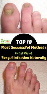 Top 10 Most Successful Methods To Get Rid Of Fungal Infection Naturally Foot Fungus Remedies Fungal Infection Skin Fungal Infection