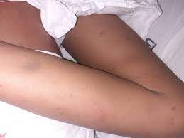 Las más comunes son a través de nariz, boca o recto y las más graves son las que pueden producirse en el cerebro, a raíz de una caída grave del número de plaquetas. Com Suspeita De Leucemia Crianca Aguarda Transferencia Para Belem Selesnafes Com