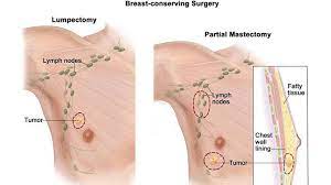 Girls' tissue grows and develops, but men's doesn't. Men Can Also Get Breast Cancer The Manicapost