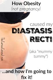 How Obesity Caused My Diastasis Recti The Curious Coconut