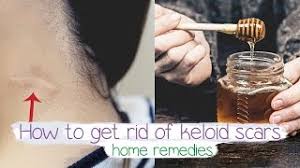 How to get rid of keloid scars. How To Get Rid Of Keloid Scars Fast Home Remedy Youtube
