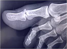 Fractures of the toes and forefoot are quite common. Avulsion Fracture In Distal Phalanx Of Left Great Toe A Rare Unnoticed Karate Sports Injury Rahman Journal Of Current Surgery