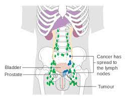 My dad was diagnosed with metastatic prostate cancer 2 months ago. Prostate Cancer Wikiwand