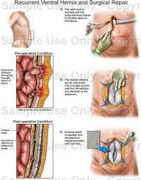 Doctors For Hernia Surgery In Chennai Abdominal Surgery Hernia Repair Abdominal Hernia