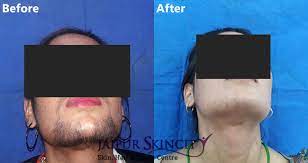 At laser chic, we divide up laser hair removal side effects into 3 categories: Permanent Laser Hair Removal Treatment Jaipur Skincity