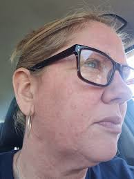 Is it normal to get red blotchy face after intense workouts?