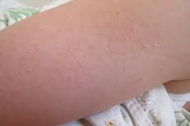 Med vår enkla sökfunktion kan du enkelt söka dig fram för att exempelvis hitta företag/privatpersoner på en viss plats, postadresser, vägbeskrivningar till olika resmål etc. Knoppet Udslaet Keratosis Pilaris Patienthandbogen Pa Sundhed Dk