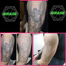 Welcome to the skin clinic in shrewsbury, shropshire (01743 343433). Ierase Tattoo Removal And Tattoo Consultation Home Facebook