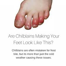 Foot Health Do You Have Cold Painful Feet In The Winter That Blister You Just May Have Chilblains Kyforward Com Cold Feet Remedy Foot Remedies Foot Health
