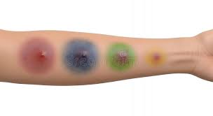 Image result for phlegmon of hand)