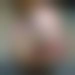 Image result for toe amputation