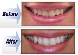Profile for SMILE Bright Laser Teeth Whitening