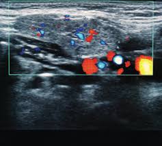 Ultrasound In Rheumatology Past Present Future The Rheumatologist