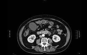 Image result for Choledocholithiasis