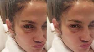 Check spelling or type a new query. Jennifer Lopez Explains Her Black Eye I M A Fighter Too Youtube